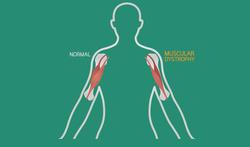 Spierdystrofie van Duchenne: komt dit alleen voor bij jongens?