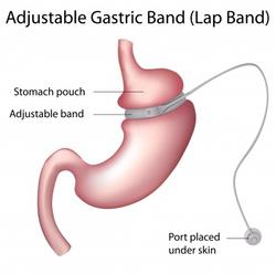 123-obesit-gastric-band-170-12.jpg