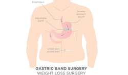 123-omaagverkl-overgew-gastric-b-10-18.png