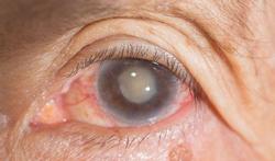 123-oog-cataract-12-17.jpg