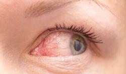 Rood oog: oorzaken en behandeling van een oogontsteking (conjunctivitis)