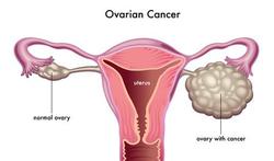 Eierstokkanker: een verraderlijke kanker die aandacht verdient