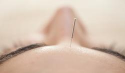 Migraine : l’acupuncture pour diminuer les crises ?