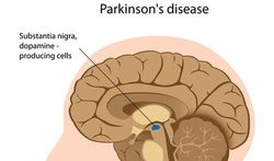 Nieuwe benadering Parkinson-onderzoek