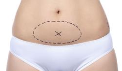 Wat is een mini-buikwandcorrectie of mini-abdominoplastiek?