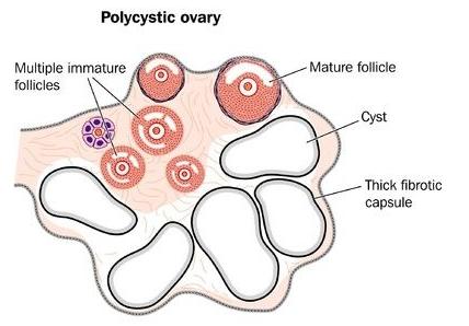123-polycyst-ovarium-PCOS-12-15-300.jpg