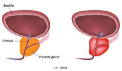 Ontsteking van de prostaat: symptomen en behandeling van prostatitis