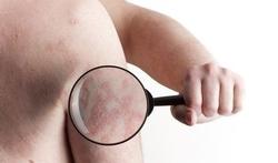 Vaker huidkanker bij sommige behandelingen tegen psoriasis