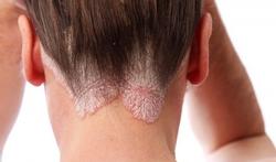 Psoriasis van de hoofdhuid: symptomen en behandeling