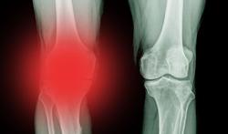 Experts raden kijkoperaties knie af bij artrose
