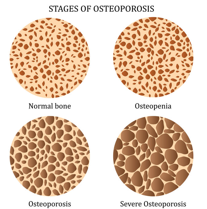 123-soorten-osteoporose-03-19.png