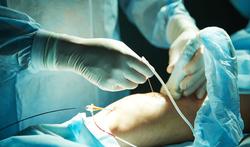 Nieuwe behandelingen van spataders: patiënten sneller op de been