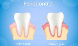 123-tand-gezond-parodont-periodont-02-18.jpg