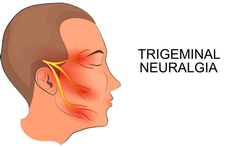 Trigeminus Neuralgie (TN)