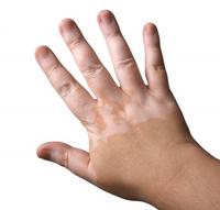 123-vitiligo-200_07.jpg