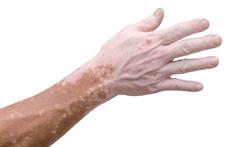 Moeten mensen met vitiligo uit de zon blijven?