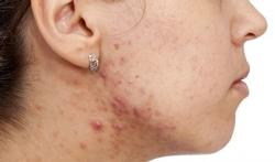 123-vr-acne-gezicht-08-16.jpg