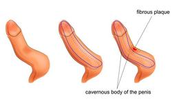 Kromstand van de penis of Ziekte van Peyronie