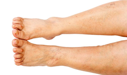 Pijnlijke benen door chronische veneuze insufficiëntie (CVI): oorzaken en behandeling