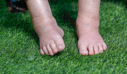 Oedeem: Wanneer zijn gezwollen benen, enkels en voeten gevaarlijk? 