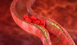 (Slag)aderverkalking of atherosclerose: symptomen en behandeling