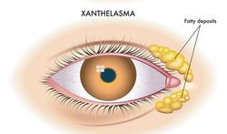 Xanthelasma: witte of gele vetbolletjes rond de ogen