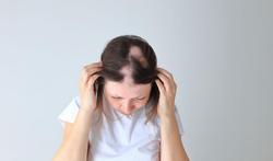 Alopecia areata: als je plots kale plekken krijgt