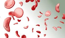 Sikkelcelziekte of sikkelcelanemie: een erfelijke vorm van bloedarmoede (anemie)