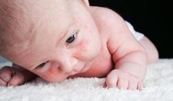 Rode vlekjes en huiduitslag: alles over babyacne