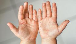 Hoe herken je de hand-voet-mondziekte en wat kan je doen?