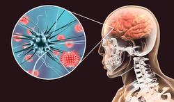 Meningitis of hersenvliesontsteking: twee soorten