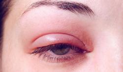 Gezwollen ooglid: wat kan je doen aan een ooglidontsteking? (Blefaritis)