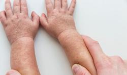 Taches ou boutons rouges sur la peau : de quelle maladie infantile s'agit-il ?