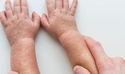 Scarlatine : symptômes, contagion, éviction scolaire, traitements