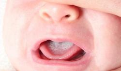 Que faire si bébé a un frein de langue trop court?