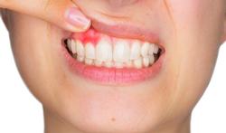 Alles over tandvleesontstekingen of gingivitis