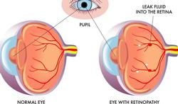 Wat is diabetische retinopathie en wat merkt u ervan?