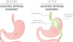 Voedingsaanpassingen na obesitaschirurgie