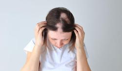 123m-alopecia-areata-haar-haren-17-2-21.jpg