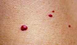 C'est quoi ces petits points rouges sur la peau : angiome rubis ou pétéchie ?