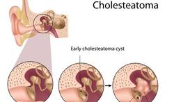 Cholesteatoom: een agressieve middenoorontsteking