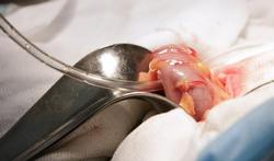 Malrotatie: een abnormale kronkel in de darmen