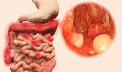 Zijn darmpoliepen gevaarlijk?