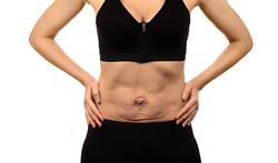 Diastasis du ventre : causes, symptômes, traitements