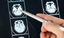Vidéo - Méningiome au cerveau : l'intervention chirurgicale
