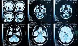 123m-hersenen-scan-beroerte-5-4.jpg