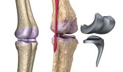 Prothèse de genou et de hanche : quelle durée de vie ?