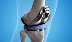 Knieprothesen: hoe tevreden zijn patiënten?