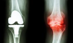 Prothèse de genou : quels risques d’infection ?