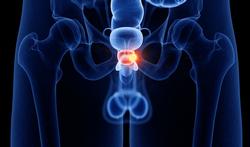 Cancer de la prostate : les lourdes conséquences du traitement